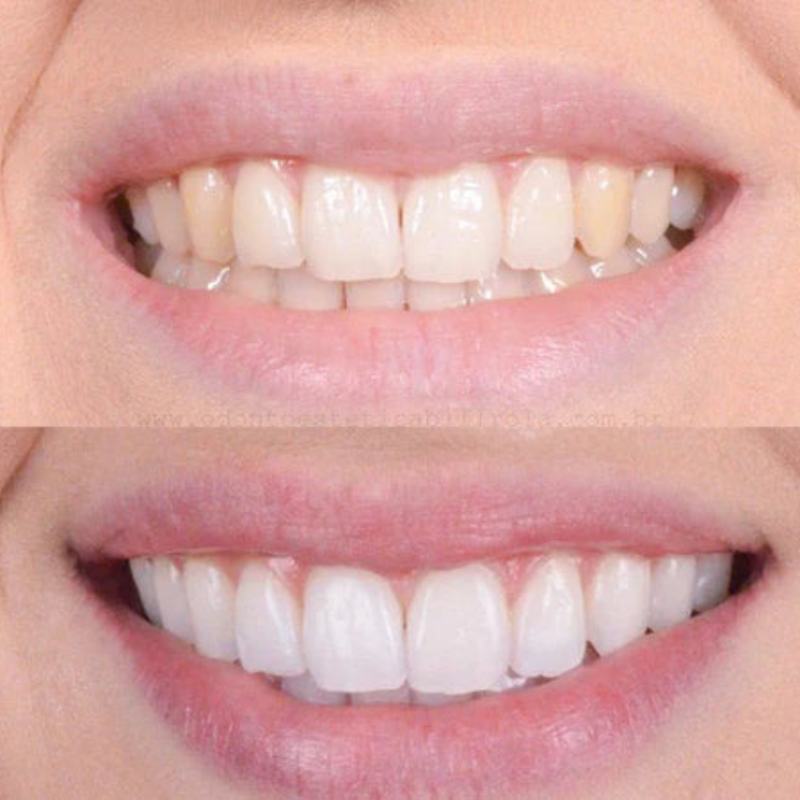 PearlWhite – Snelle Tandbleking Voor Een Stralende Glimlach 